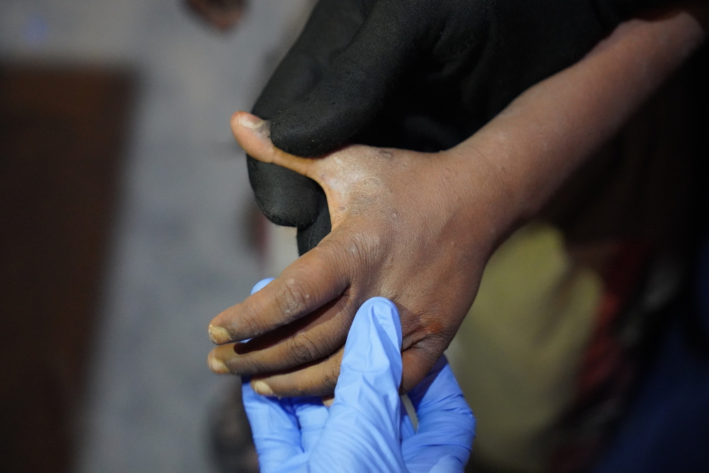 Scabies outbreak in Cox's Bazar. © Farah Tanjee/MSF
