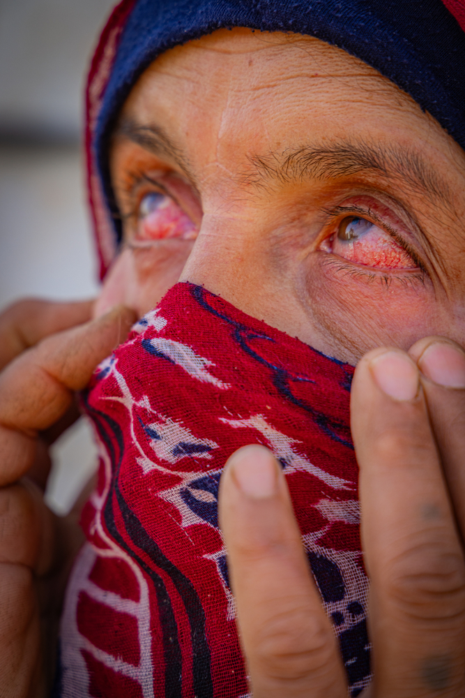 A Syrian woman shows her bloodshot eyes to the camera. Economic hardship and fear of being stopped at checkpoints prevent many refugees from accessing healthcare. © Carmen Yahchouchi for MSF