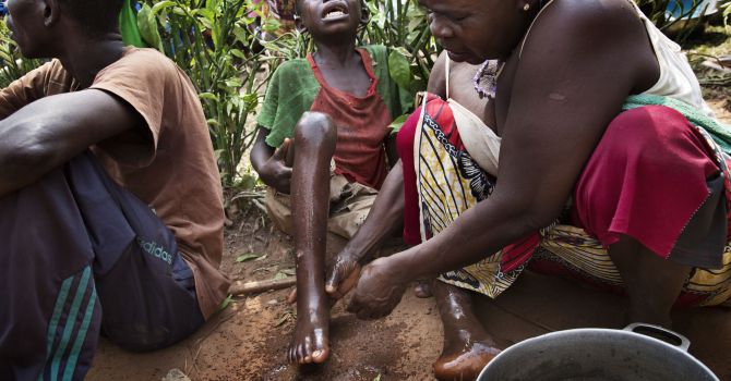 一名兒童在逃離襲擊期間受傷，傷口受到感染，在博桑戈阿接受治療。©Marcus BLEASDALE/VII