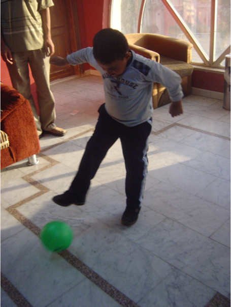 More than two years after his first arrival to the MSF-run surgical hospital in Amman, Ali is finally able to stand up and play again with the help of prosthetic limbs and several surgical operations. © MSF 