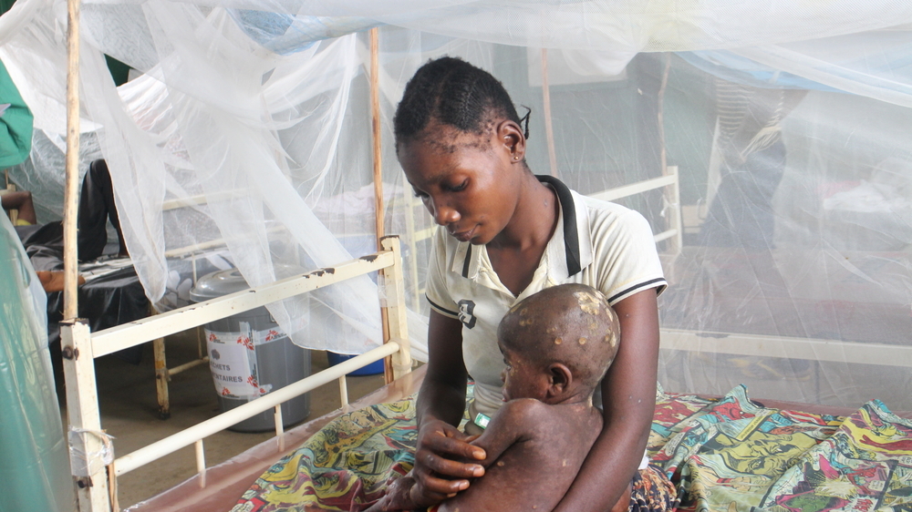 一名一歲患猴痘的病童入住由無國界醫生支援的博隆巴綜合轉介醫院。© MSF/Alain Duhamel Ntungane